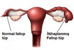 pelvik inflamatuar hastalık